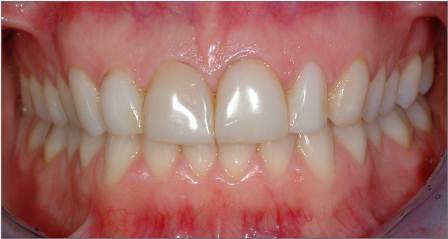 Veneers before